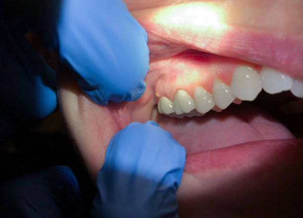 Best Emergency Wisdom Teeth Removal in Chappaqua, NY